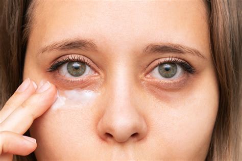 Allergies: Congestion and inflammation from allergies can sometimes exacerbate under-<b>eye</b> puffiness. . Adderall sunken eyes